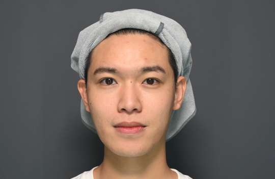 療程前｜AI美光針｜Allen